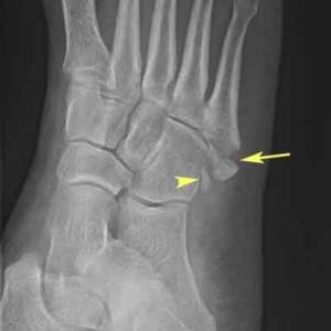 Avulsion Fracture 5th Met