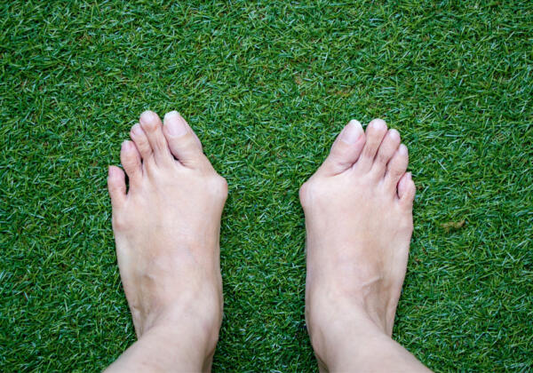 Bunion-photo