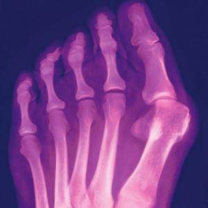 Bunion X-ray