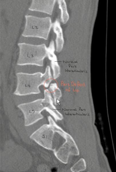 Pars Defect Ct