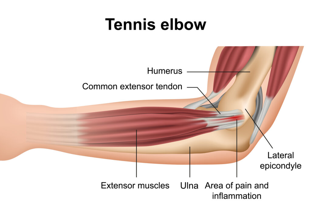 Tennis Elbow Injury 